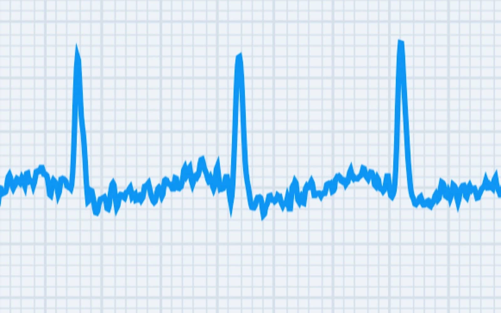 An ECG on the Withings ScanWatch